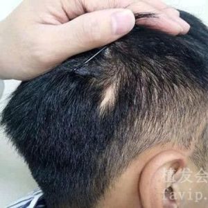 疤痕植发选择哪种方法比较好？