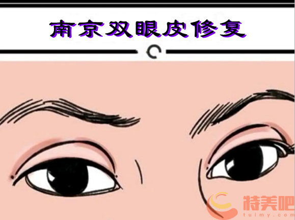 南京双眼皮修复