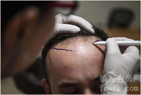 北京碧莲盛植发有哪些医生做的好？