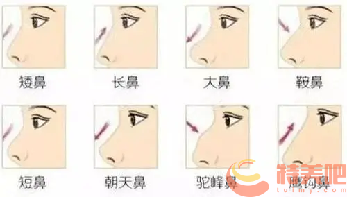 鼻子基础类型