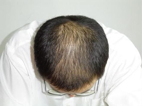 杭州头发加密植发要多少钱？