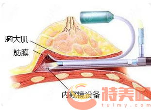 内窥镜假体隆胸