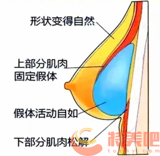 假体隆胸