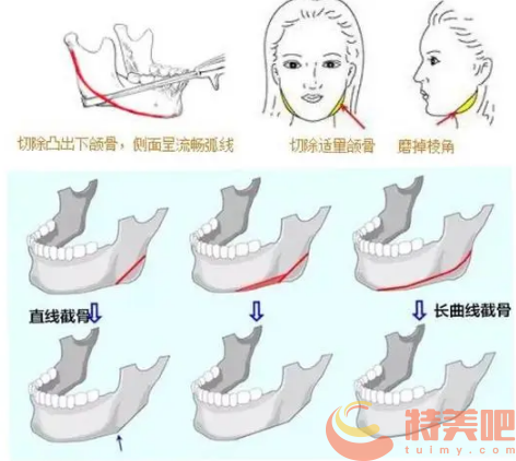 上海长曲线下颌角