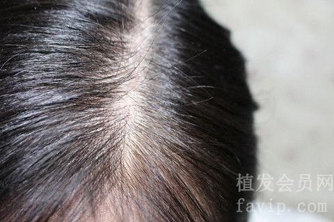 女性发缝稀疏可以用米诺地尔酊溶液治疗吗？