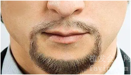做了种植胡须后胡子自然吗？