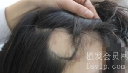 北京疤痕植发整形多少钱？