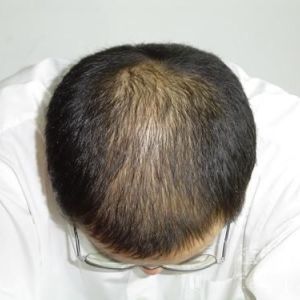 广州新生治疗脱发需要多少钱？