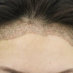 种植发际线能维持多长时间？