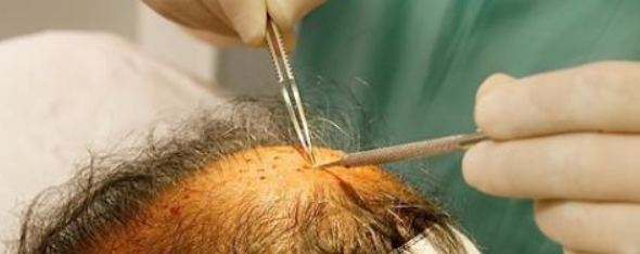 植发效果的持久性主要取决于移植的毛囊质量