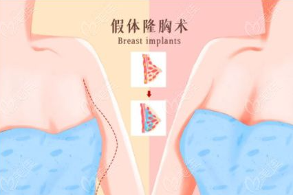 假体隆胸会影响对乳腺癌及相关乳腺疾病的筛查吗?