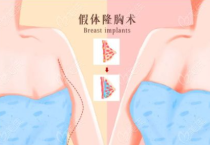 假体隆胸会影响对乳腺癌及相关乳腺疾病的筛查吗?