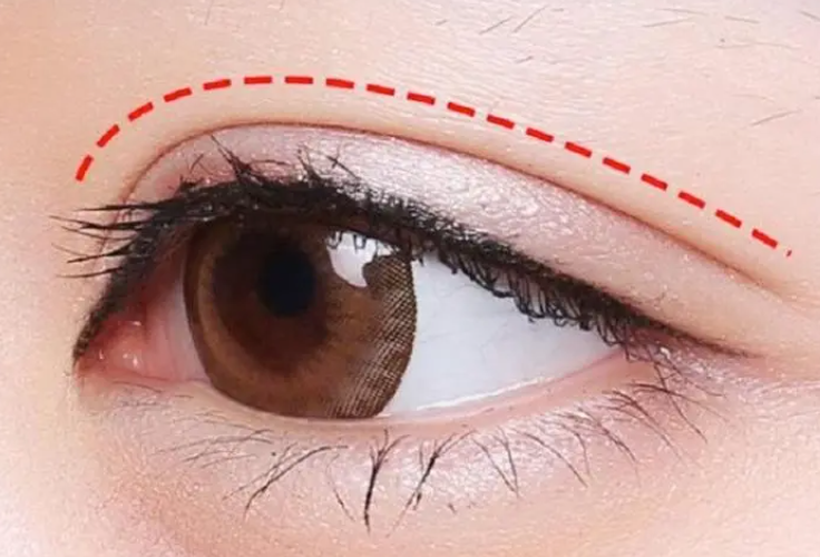 双眼皮手术术后应该注意哪些问题？更有利于恢复