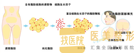 自体脂肪填充