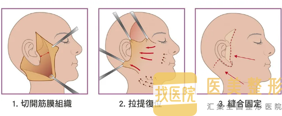 面部拉皮手术
