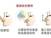 鼻综合隆鼻有哪些优点？