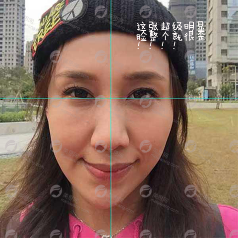 北京正颚手术恢复过程分享，两边脸终于对称了，好开心