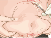 腰腹吸脂后皮肤松弛可以通过电波拉皮解决吗？