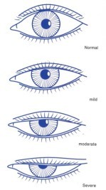 眼睛眼睑下垂手术怎么做的呢？术后有哪些注意事项？