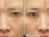 什么是真皮筋膜隆鼻手术？