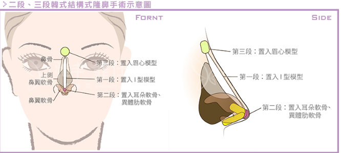 韩式隆鼻不同于传统隆鼻之处有哪些？