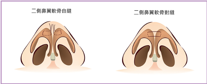 常见鼻型问题和隆鼻改善方法
