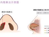 “L”型隆鼻手术方式