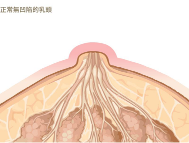 乳头凹陷乳腺癌图片