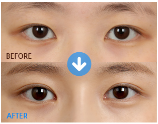 怎么通过眼型矫正获得适合自己的眼睛呢？