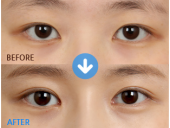 怎么通过眼型矫正获得适合自己的眼睛呢？