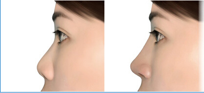 怎么才能避免隆鼻的缺点呢？