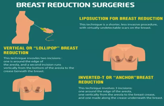 缩胸手术的方法有哪些？术前须知。
