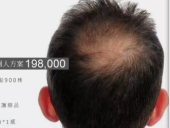 “FUE”植发想比较传统植发手术，有什么不一样呢？值得信奈吗？