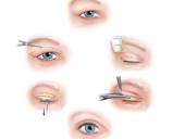 怎样的双眼皮手术才算是成功的呢？