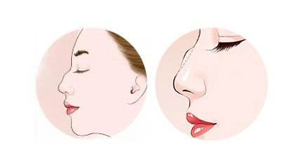 驼峰鼻该怎么矫正？