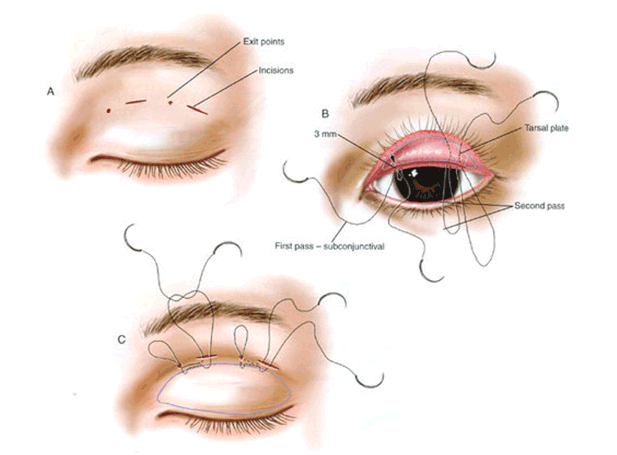 针对不同的双眼皮手术该怎么选择呢？