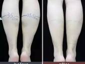 各类萝卜腿瘦腿方法，您更适合哪种方式呢？