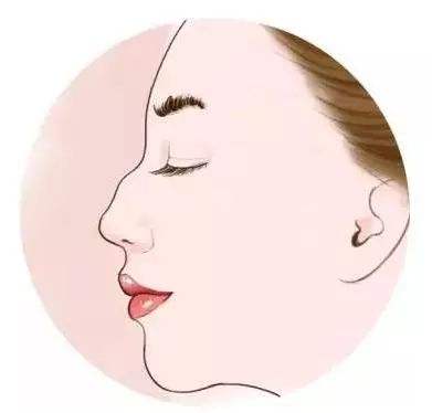 驼峰鼻-- 韩式隆鼻的完美表现
