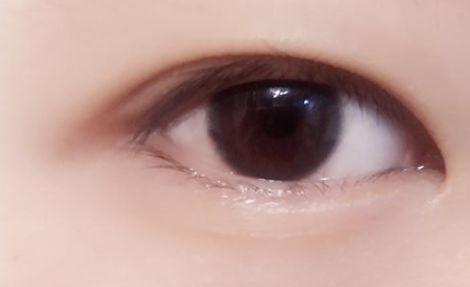韩式双眼皮手术优势在哪里？