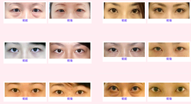 祛除眼袋有哪些方式，多适合什么样的眼部基础？
