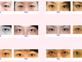 祛除眼袋有哪些方式，多适合什么样的眼部基础？