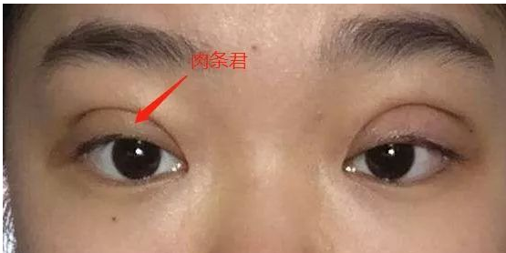 双眼皮有肉条可以修复好嘛?