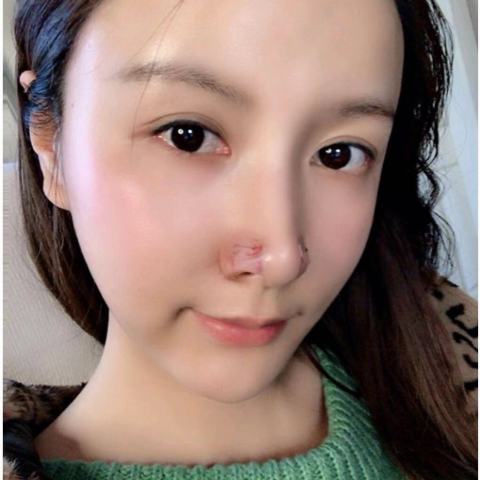 重慶華美整形醫院手術縮小鼻翼案例分享