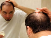 男性脱发的原因有哪些?