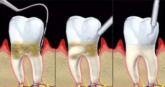 牙周护理