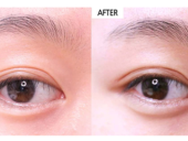 韩式双眼皮可以维持多长时间？