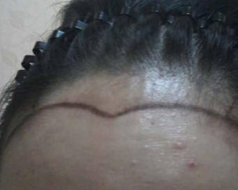 北京博士园女士发际线植发一共花了2万五植发成功了