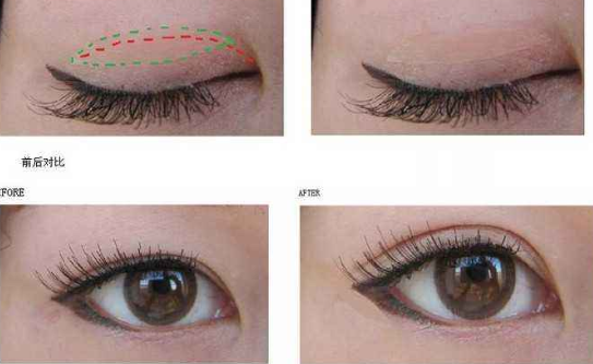 全切双眼皮和韩式双眼皮手术方式有什么区别？