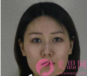 上海華美醫療美容醫院下頜角磨骨怎么樣？案例分享