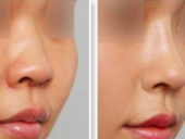 隆鼻手术的疤痕增生可以避免么?